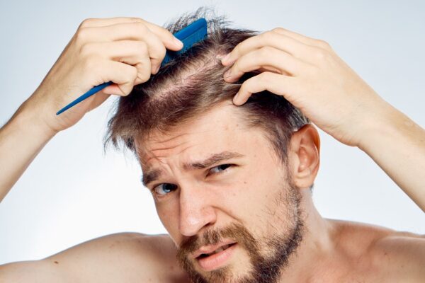 Alopecia