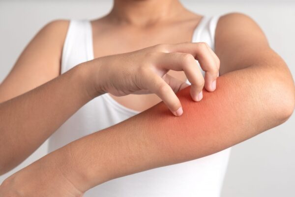 Urticaria